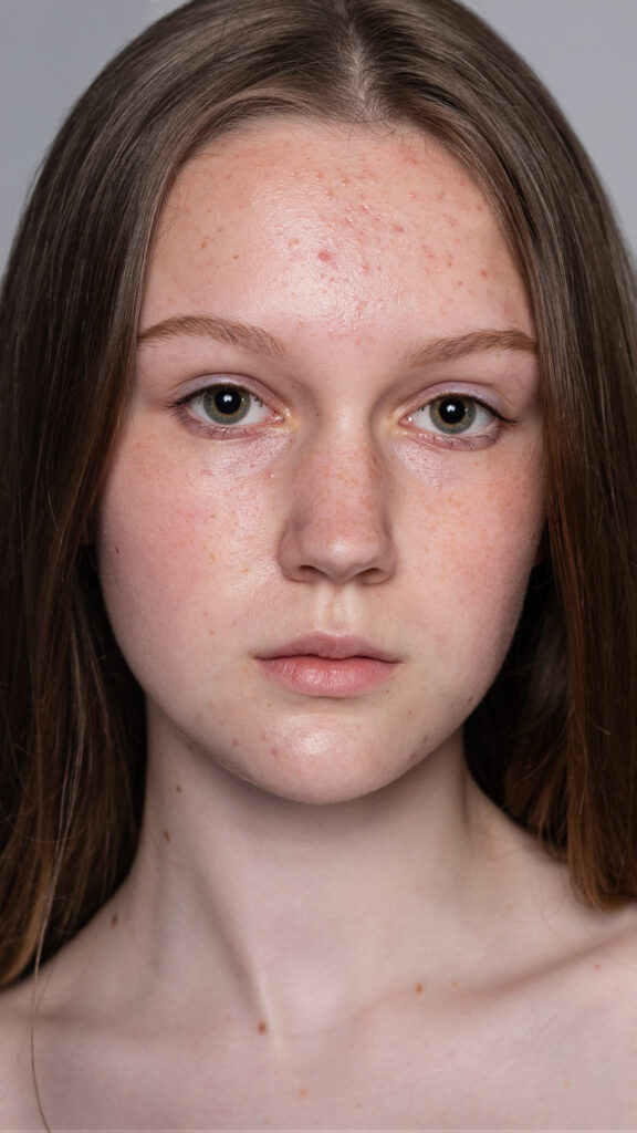 Porträt einer jungen Frau mit leichter Akne und Rötungen im Gesicht, die direkt in die Kamera blickt.
